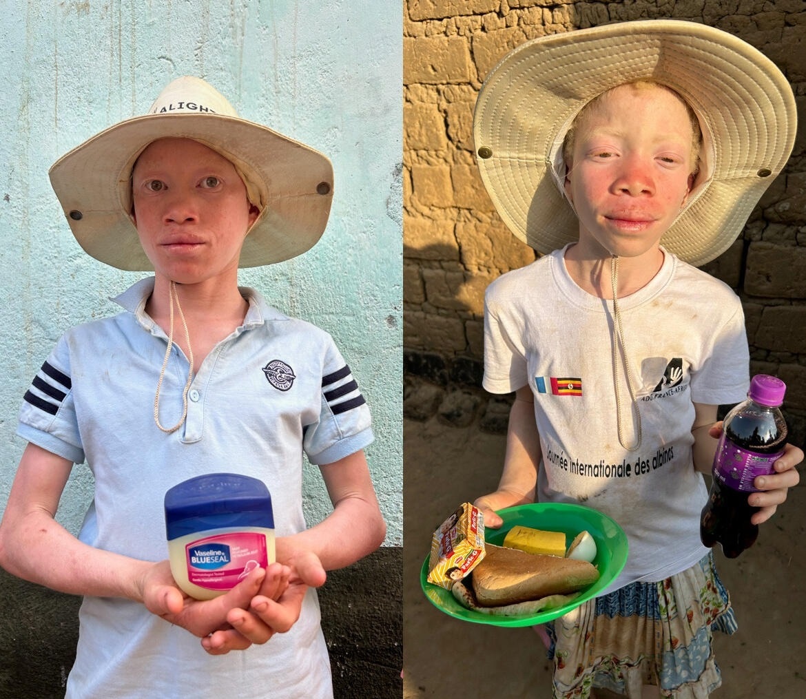Missionários ajudam albinos perseguidos para rituais de feitiçaria: “São muitos desafios”