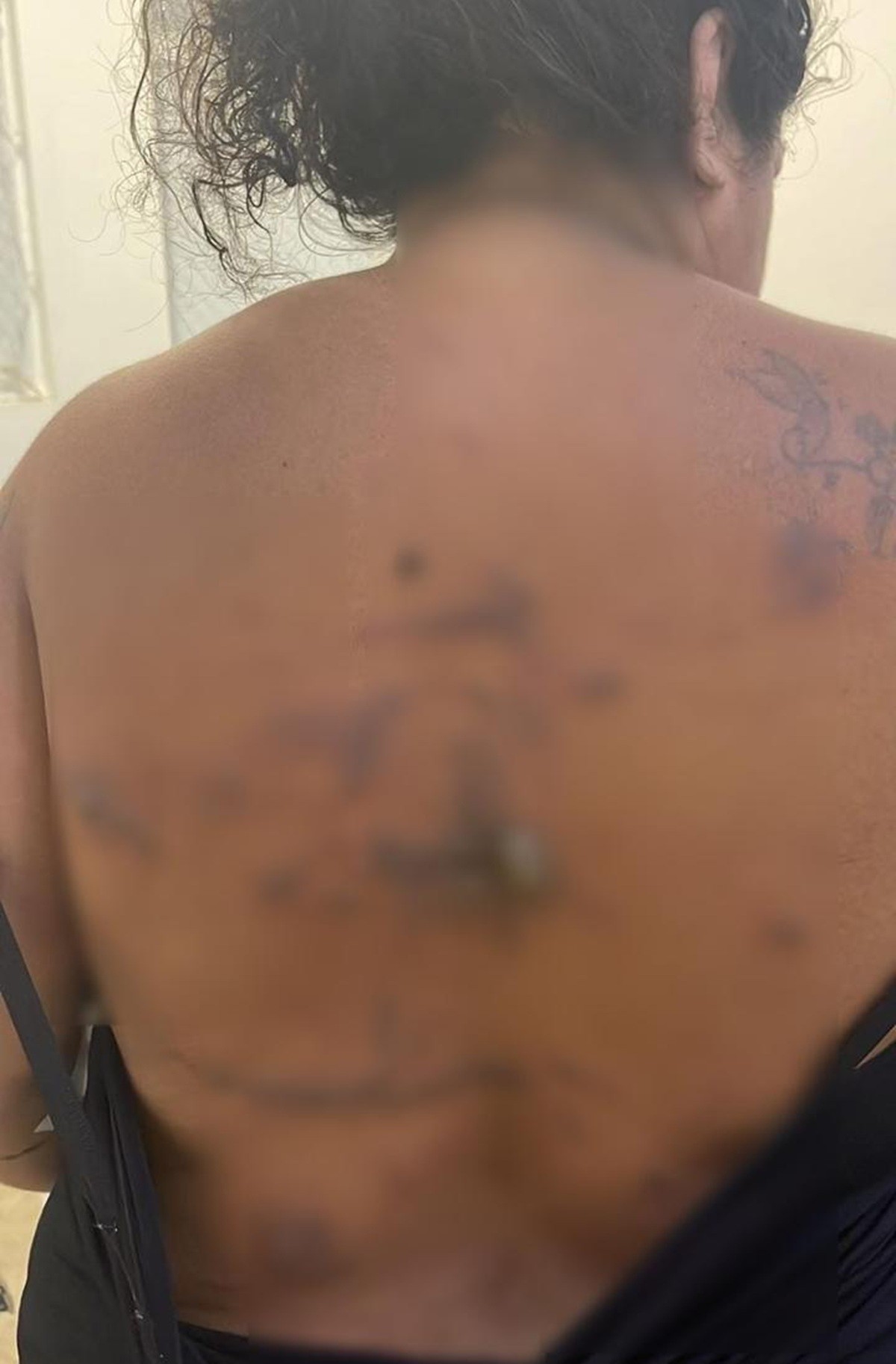 Paciente denuncia queimaduras após cesariana em Arraial do Cabo