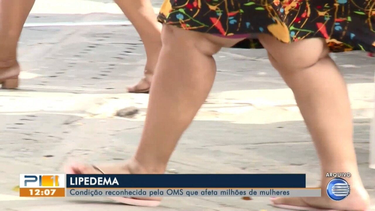 Consenso internacional redefine o que é lipedema e aponta caminhos para diagnóstico e tratamento