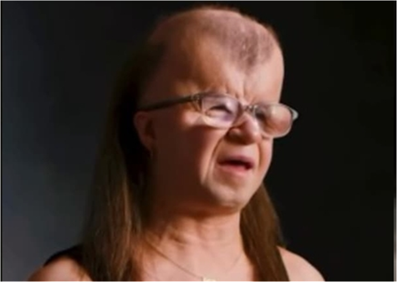 Mulher com síndrome raríssima dá lição de fé e superação