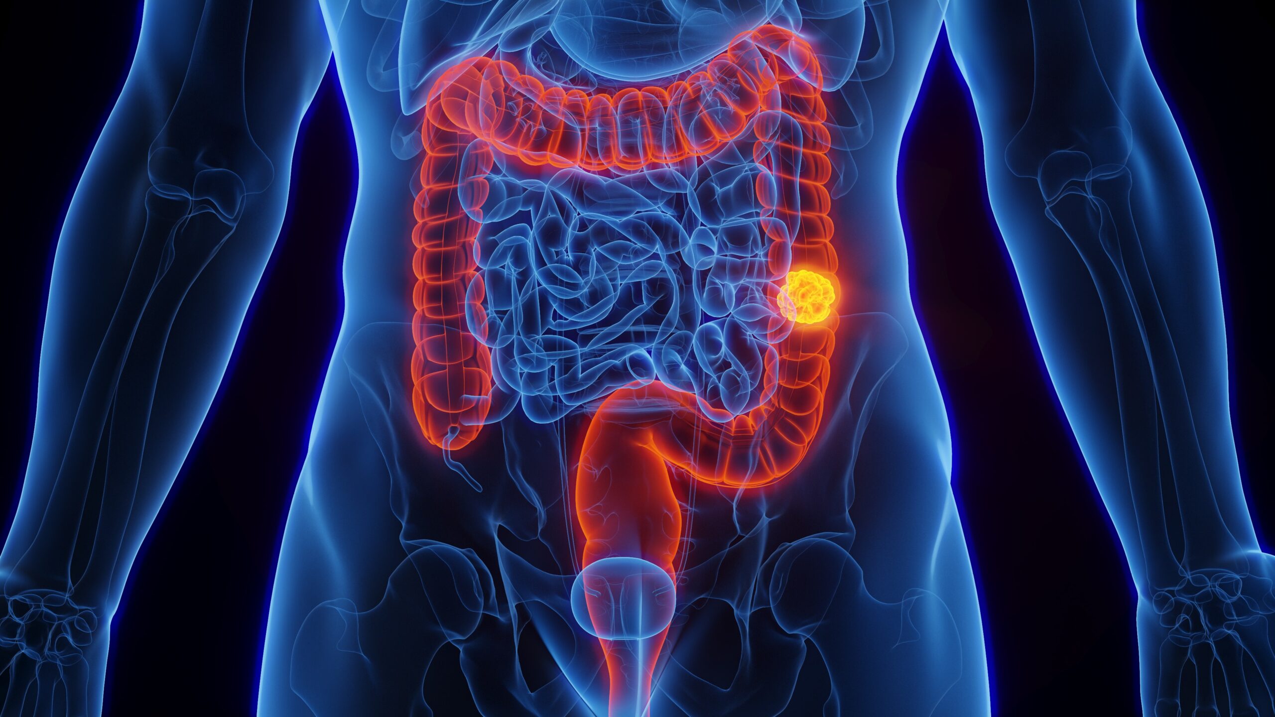 Câncer de intestino: brasileiros reconhecem sinais de alerta